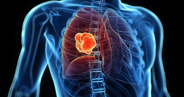 Lung cancer, caused by both smoking and non-smoking, is ...